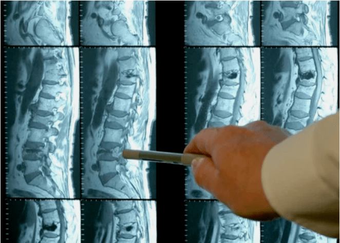 Odmiany osteochondrozy w kręgosłupie