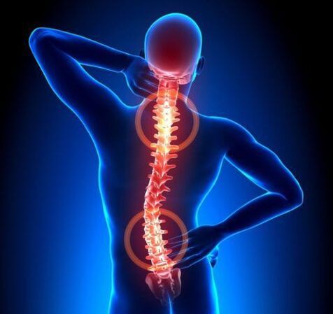Osteochondroza kręgosłupa