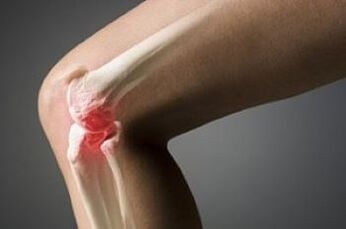 Arthrozia stawu kolanowego jest zmianą tkanki chrząstki