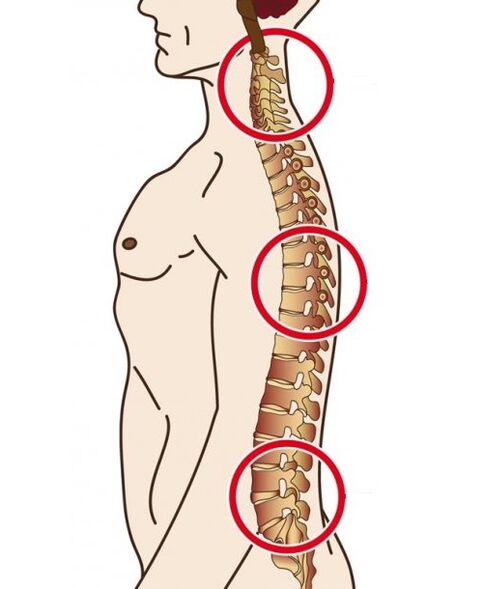 Oddziały kręgosłupa, w których występuje osteochondroza