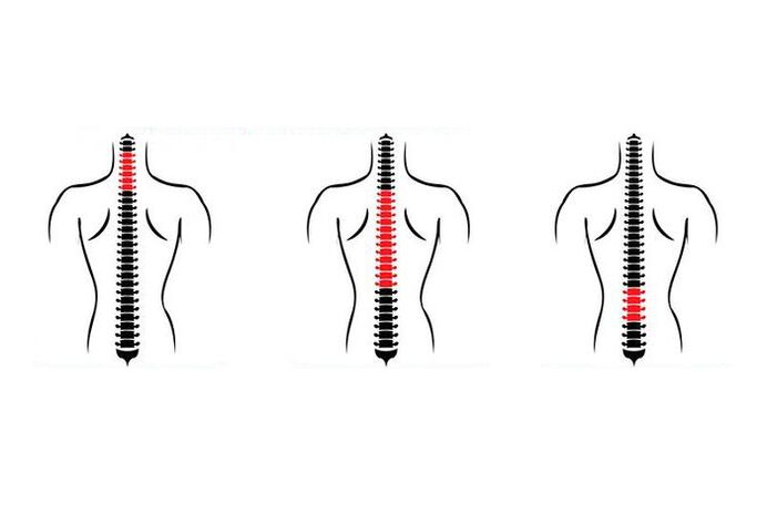 Jak objawia się osteochondroza