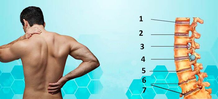 etapy rozwoju osteochondrozy