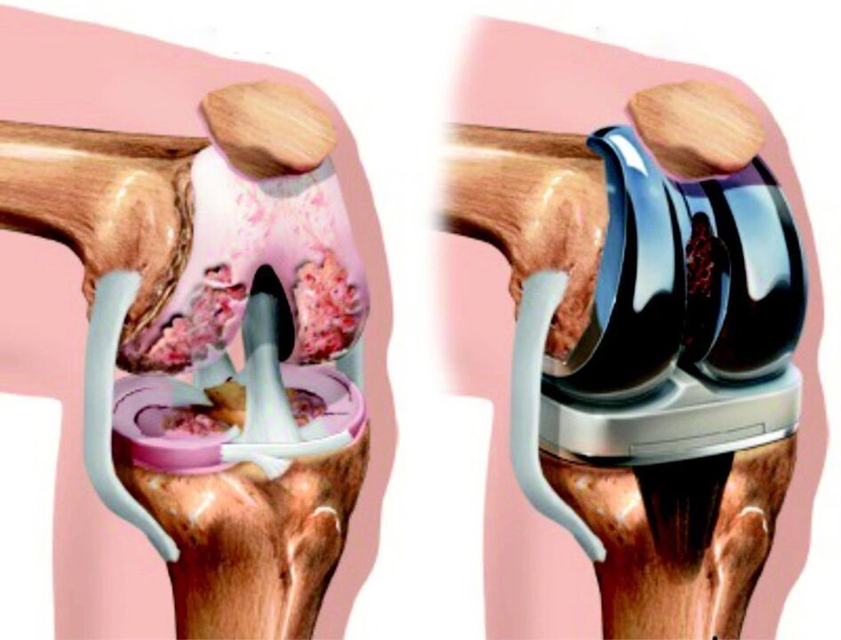 W przypadku całkowitego uszkodzenia stawu kolanowego na skutek artrozy, można go odbudować za pomocą endoprotezoplastyki